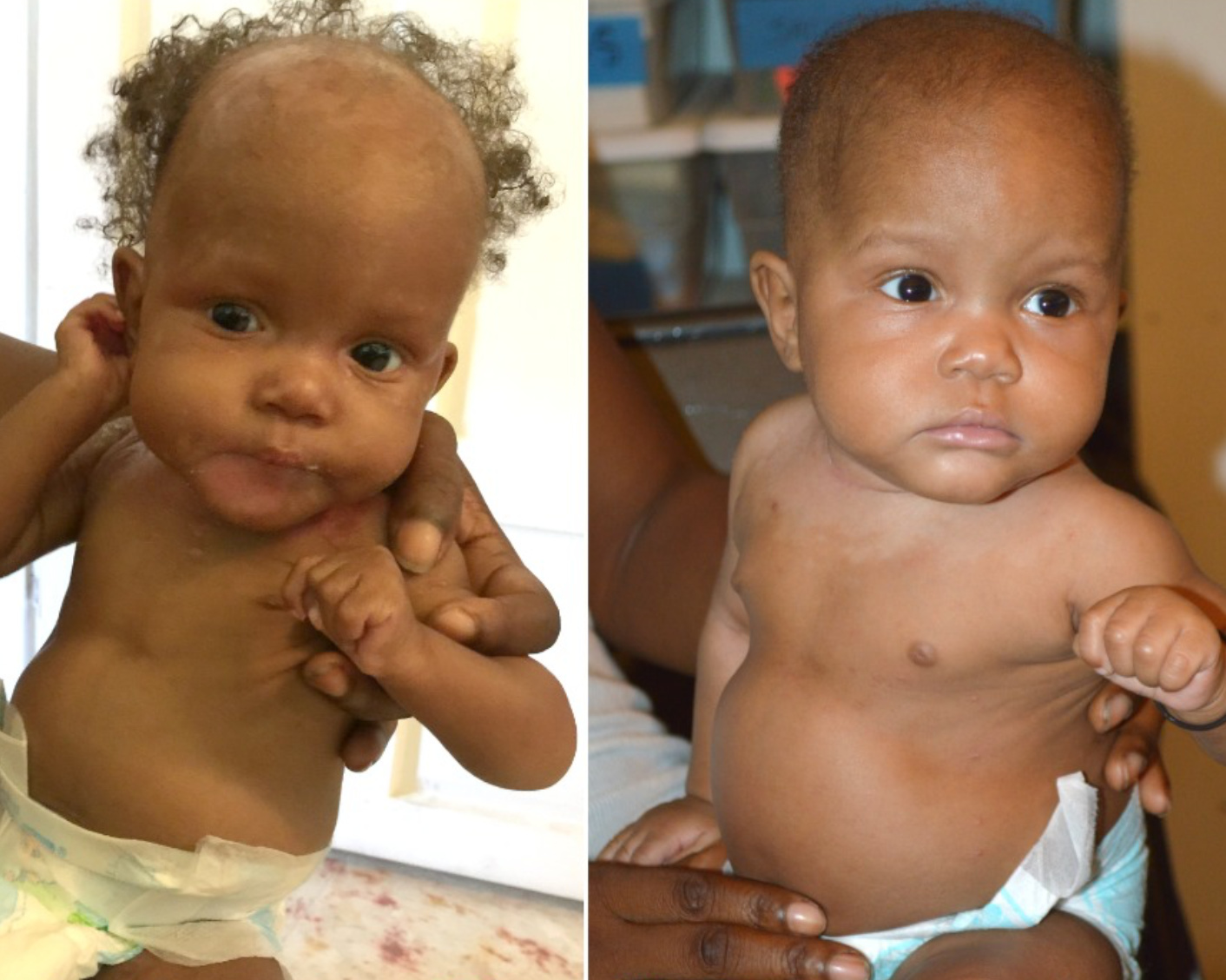 Malnutrition Treatment Children's Health Ministries